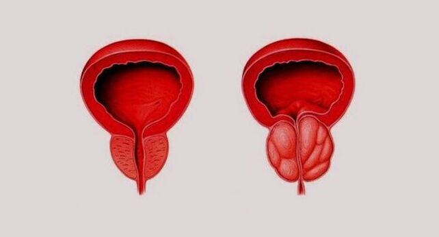 Prostate saine (à gauche) et enflammée due à une prostatite (à droite)