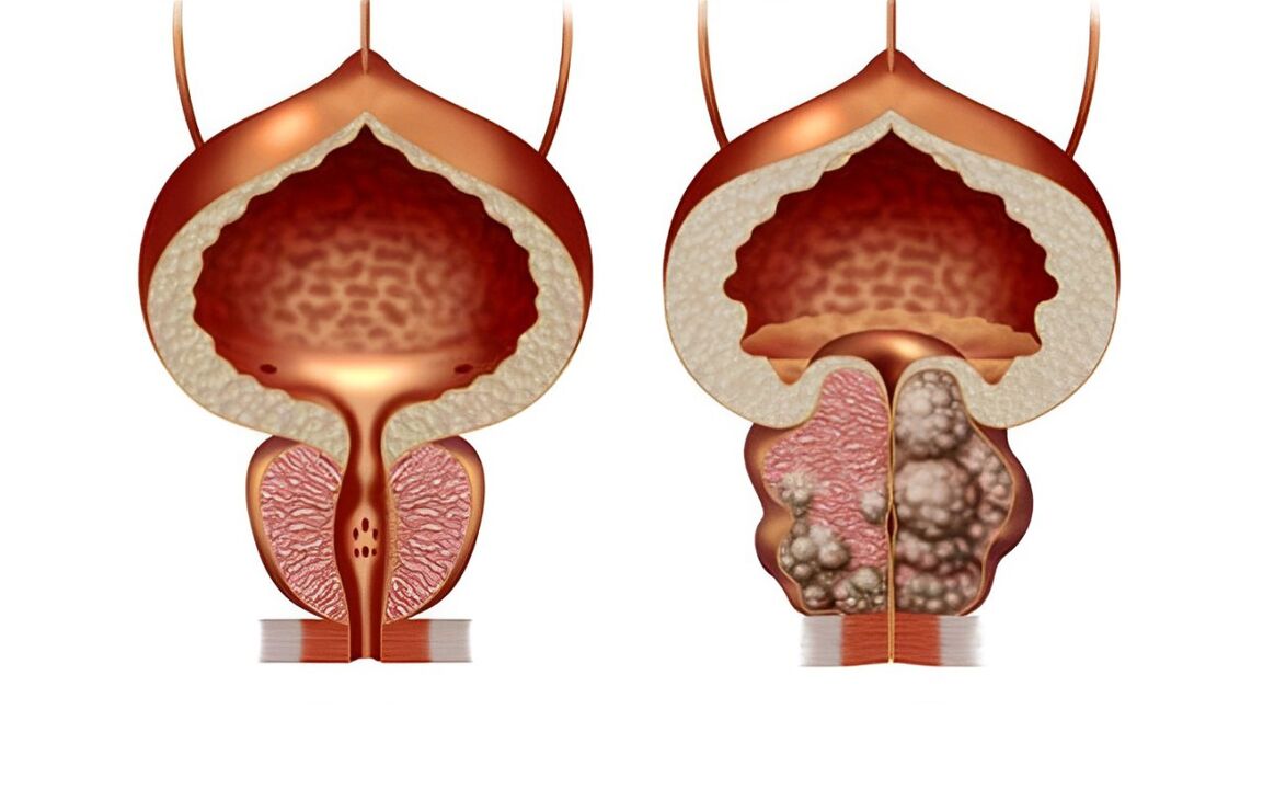 à quoi ressemble l'adénome de la prostate