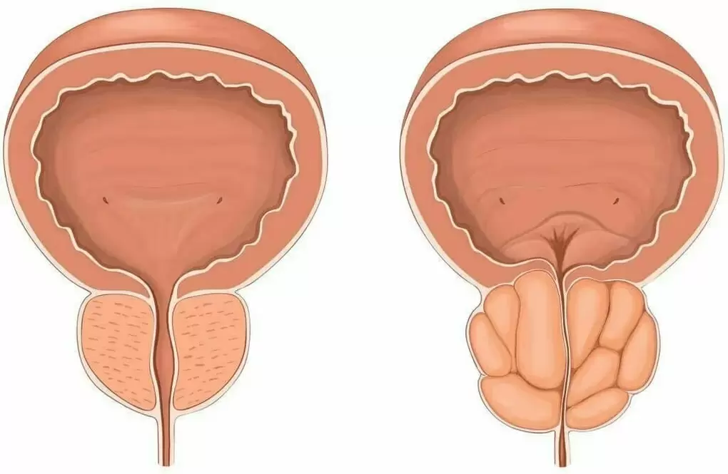 Prostate normal et prostate douloureuse